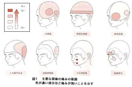 頭頂頭痛 原因|頭痛：どのように頭が痛い時病院行くべき？目安とタ。